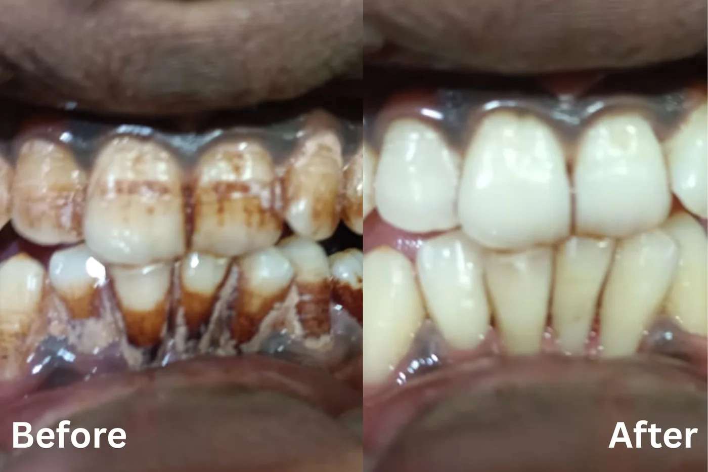 Teeth whitening result