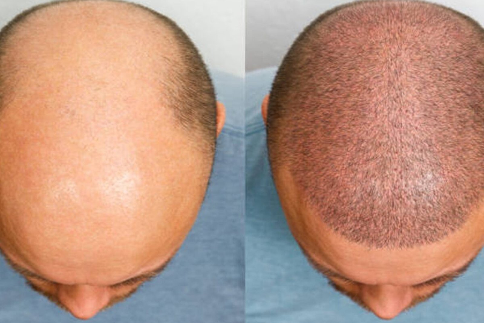 Hair transplant before and after comparison