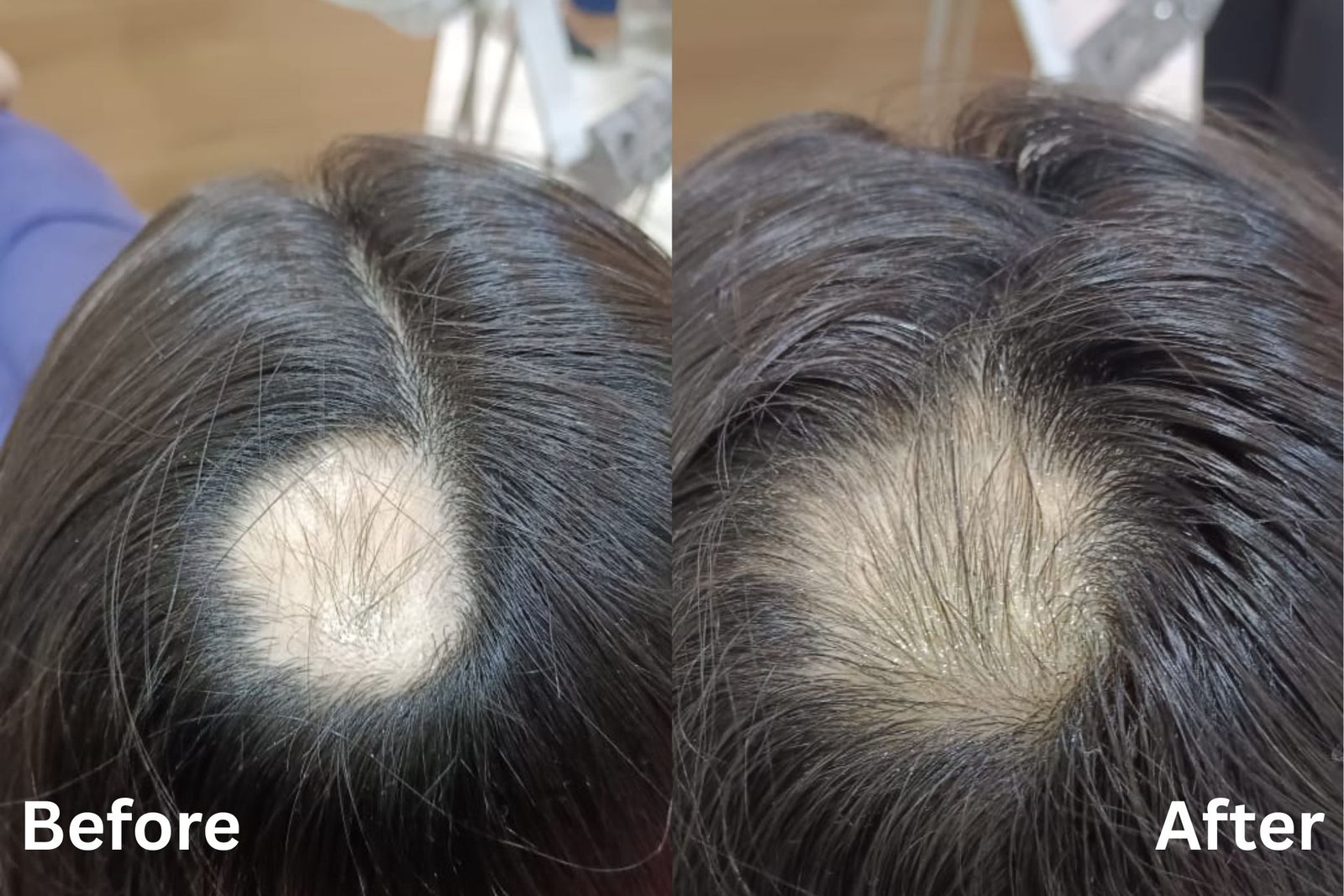 Alopecia areata progress