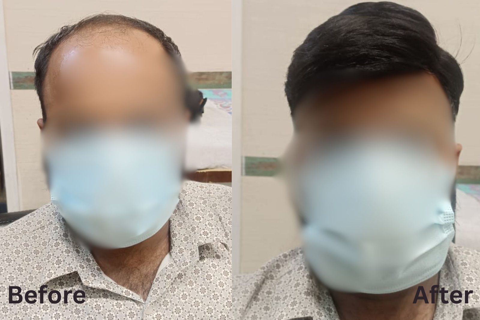 Hair patch transformation