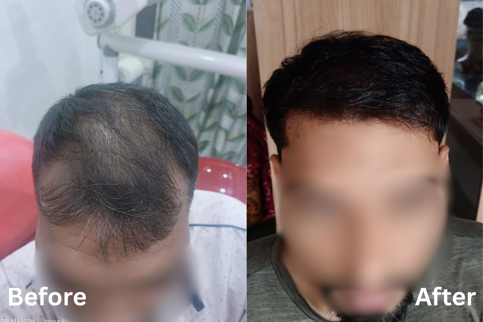 Hair transplant