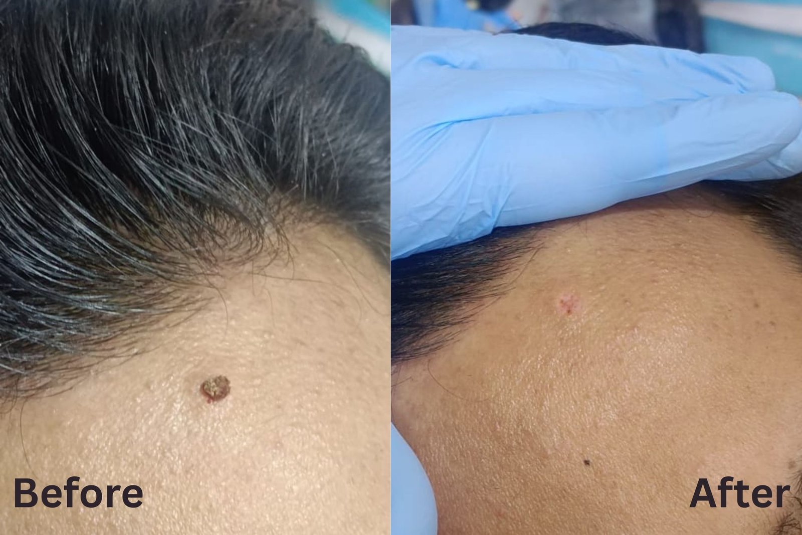 Mole removal