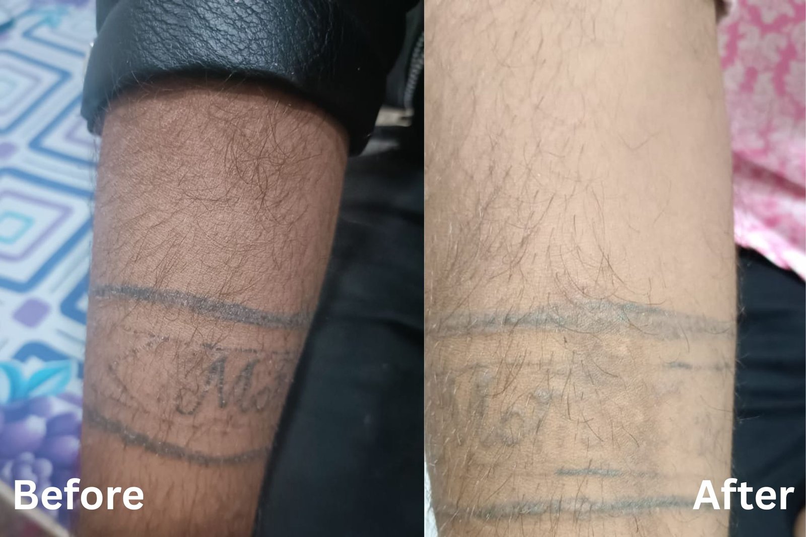 Tattoo removal