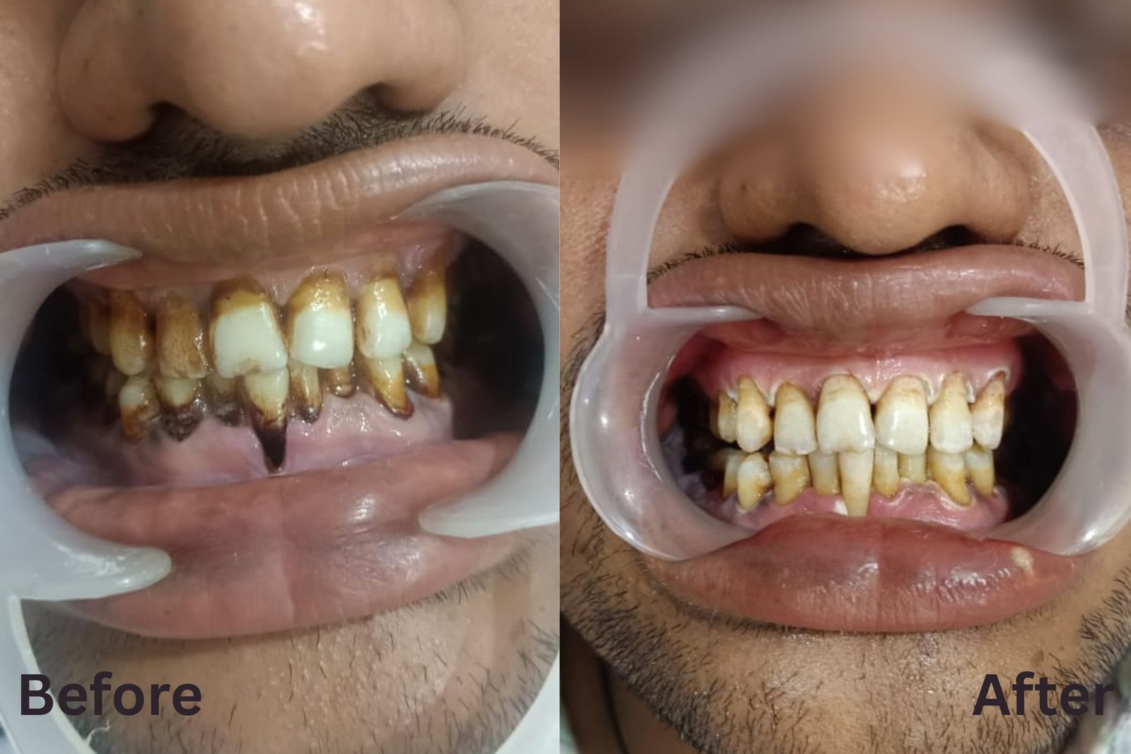 Smile care result