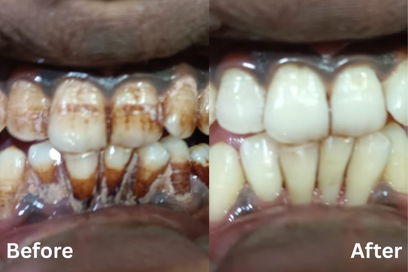Teeth whitening