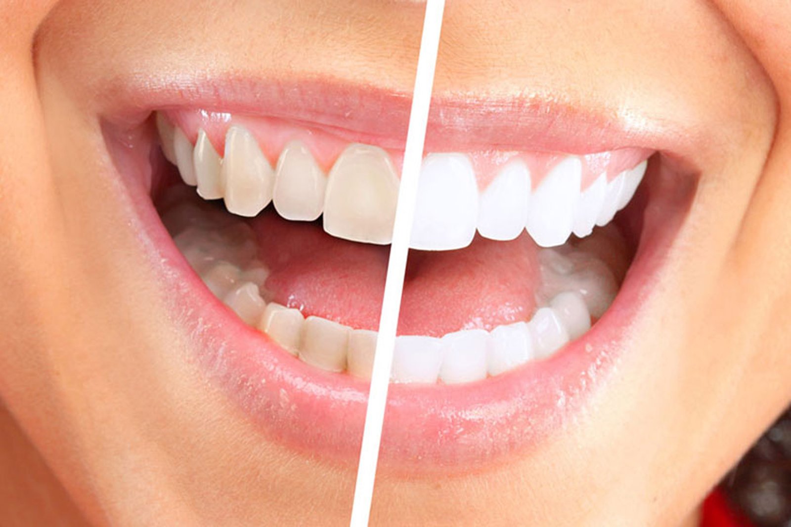 Smile Designing